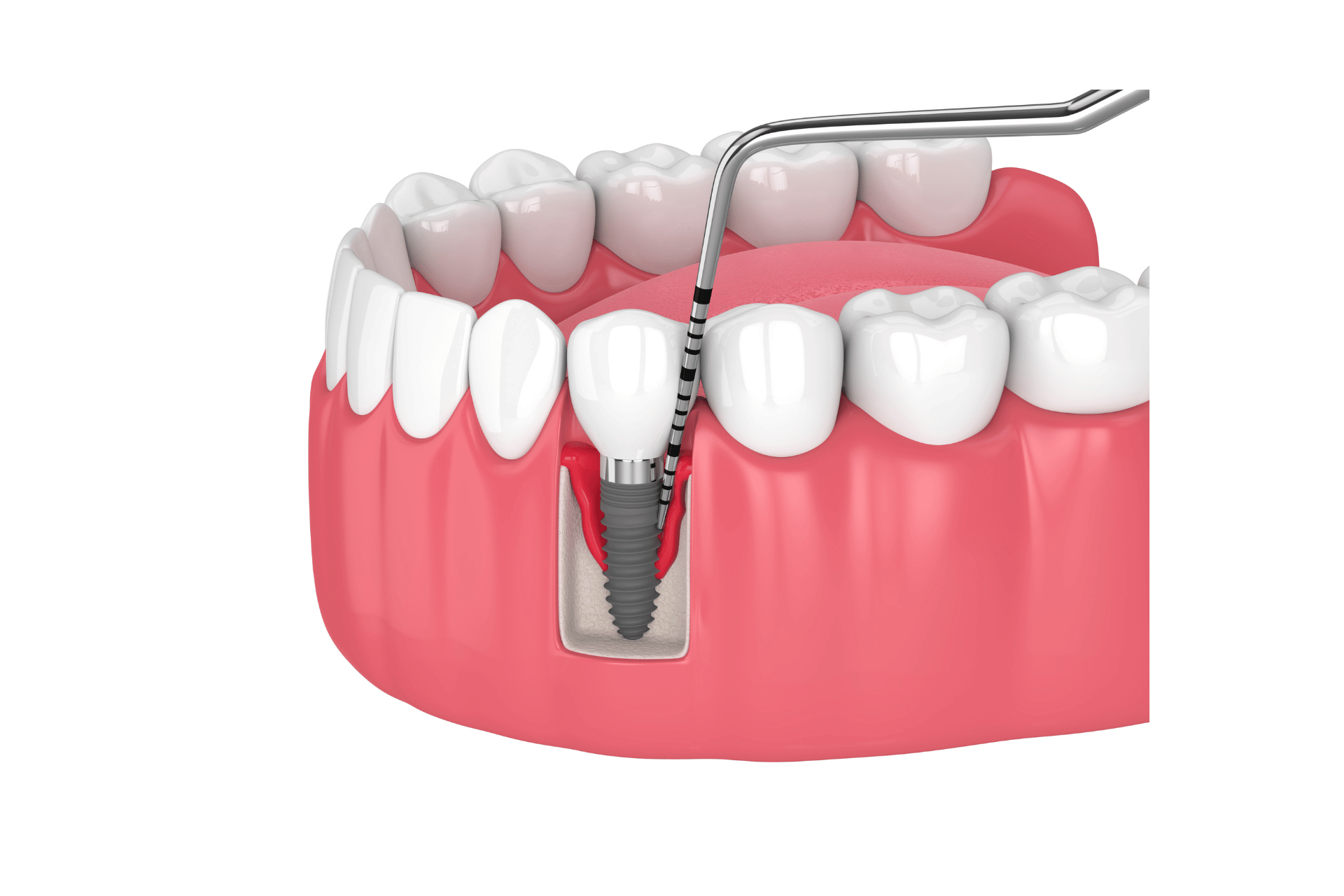 ENDODONCIA CENTRO ESTETICO DENTAL PLAYA DEL CARMEN 2 .png